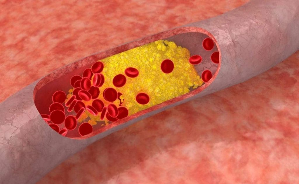 Link between high cholesterol and cancer