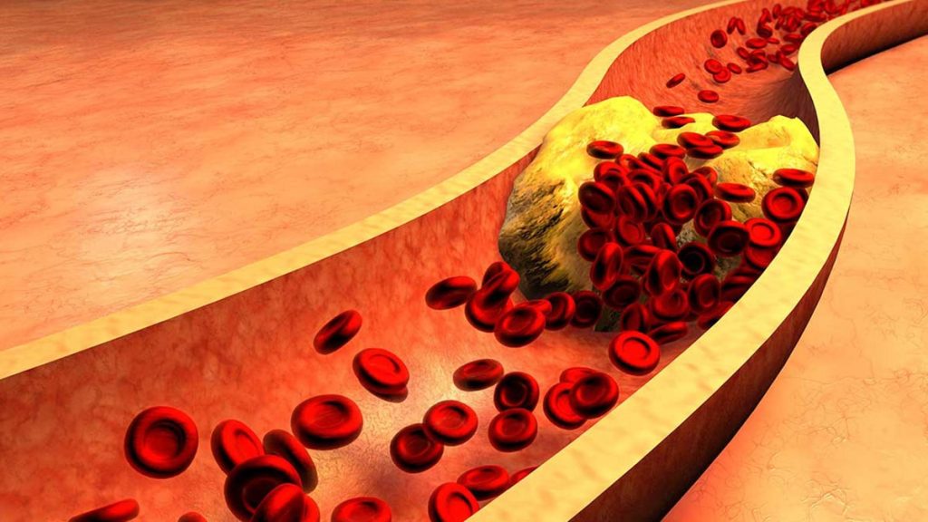 5 best tips to lower triglycerides and improve health