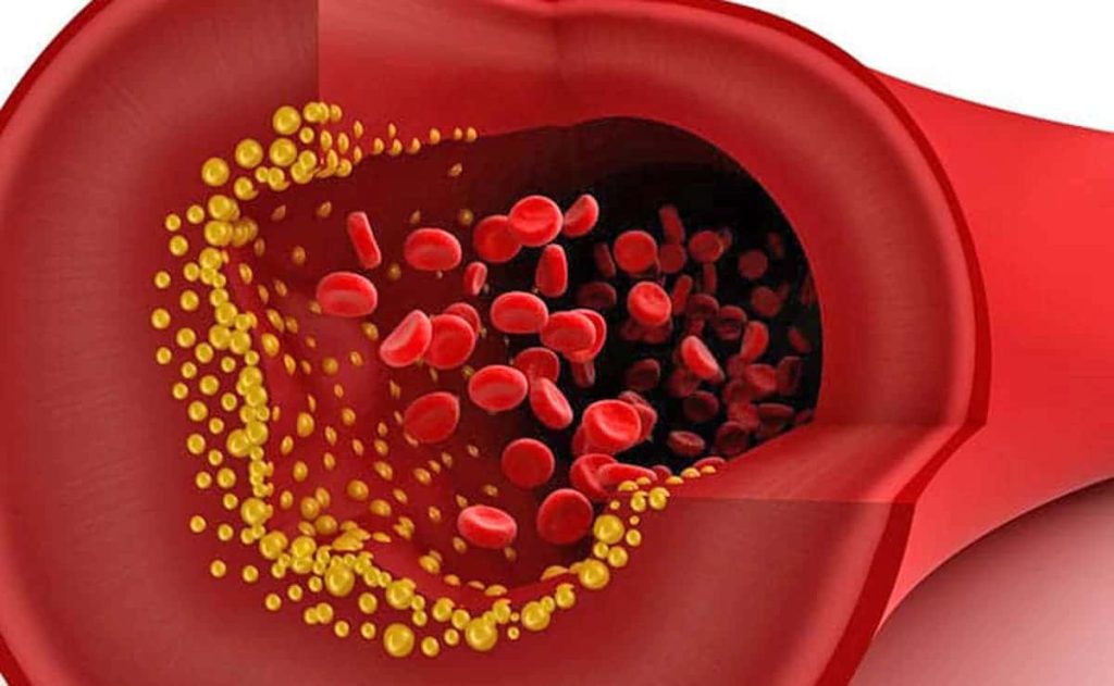 What factors can cause high blood cholesterol