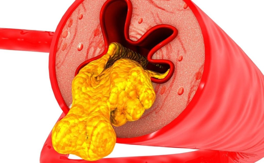 How to prevent an inherited cholesterol risk