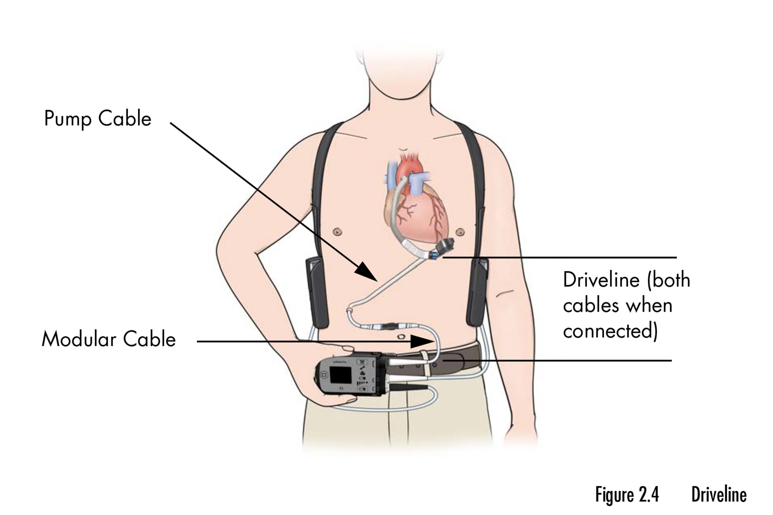 Abbott's HeartMate II and HeartMate 3 devices